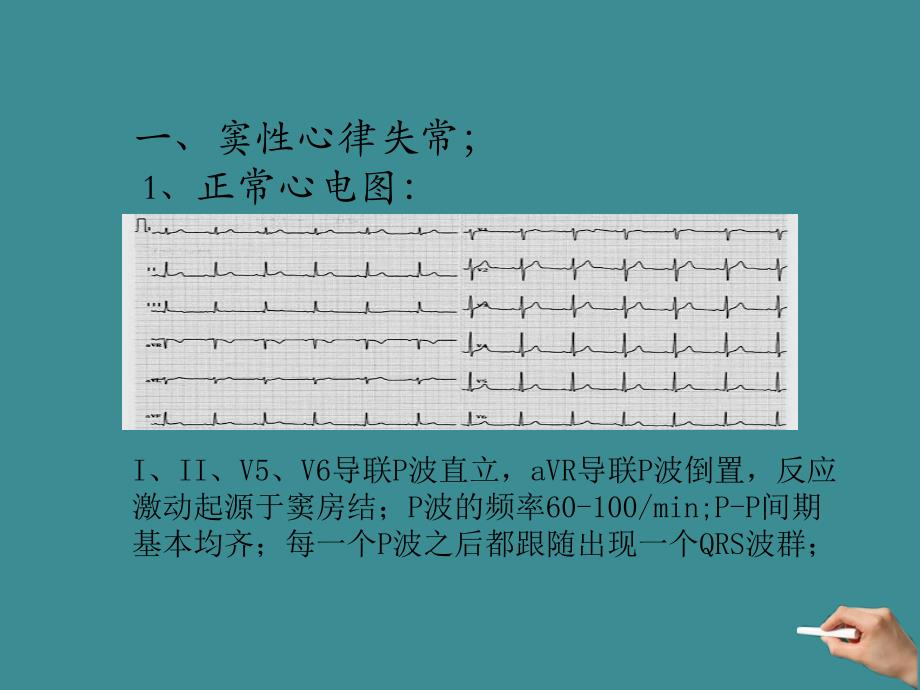 常见心电图解析._第3页