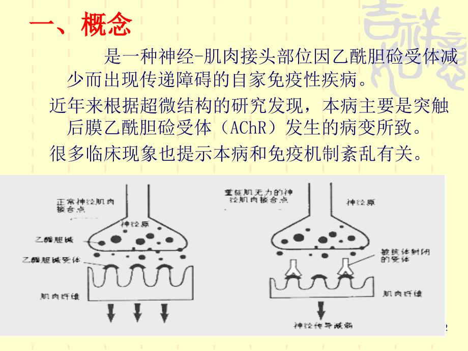 重症肌无力的护理PPT课件汇编_第2页