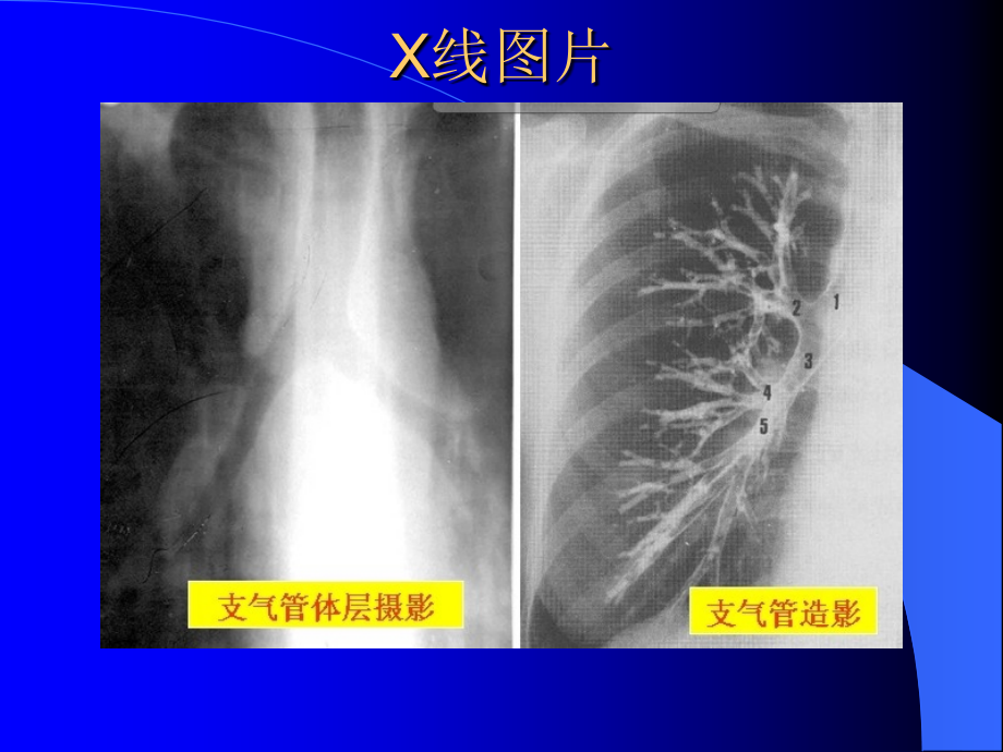 呼吸系统X线CT读片技巧精要_第4页