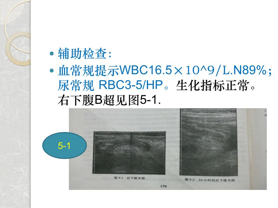 阑尾炎教学查房经典教案_第4页