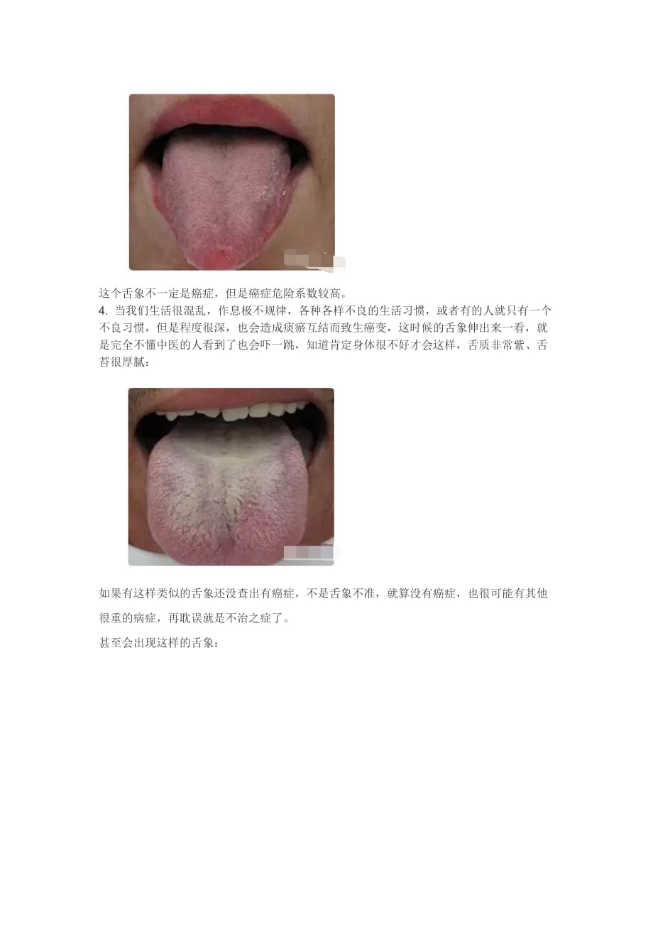 如何通过舌苔发现早期癌症_第3页