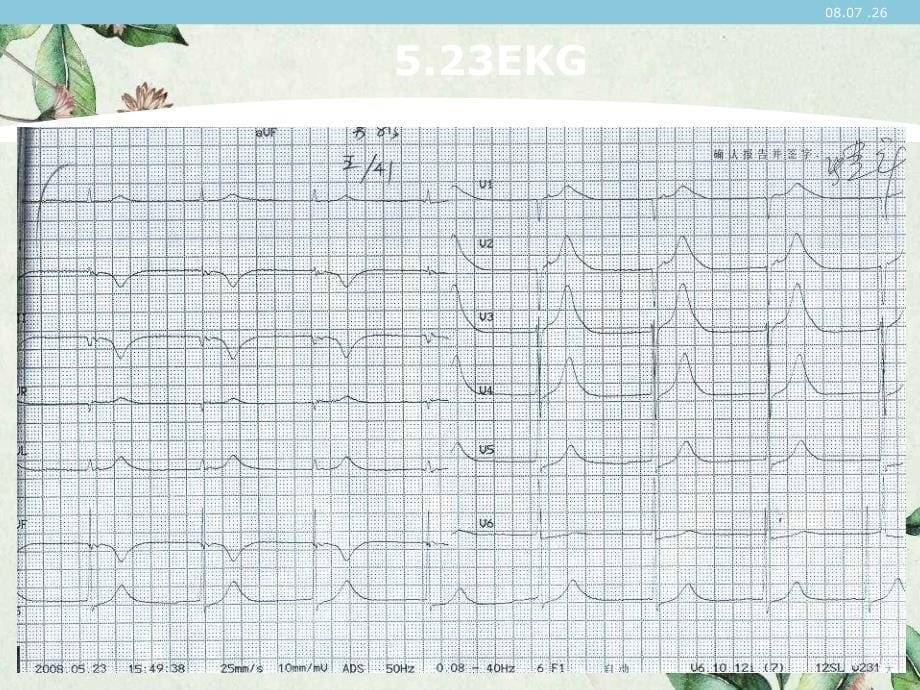 st抬高clbbbⅲoav阻滞_第5页