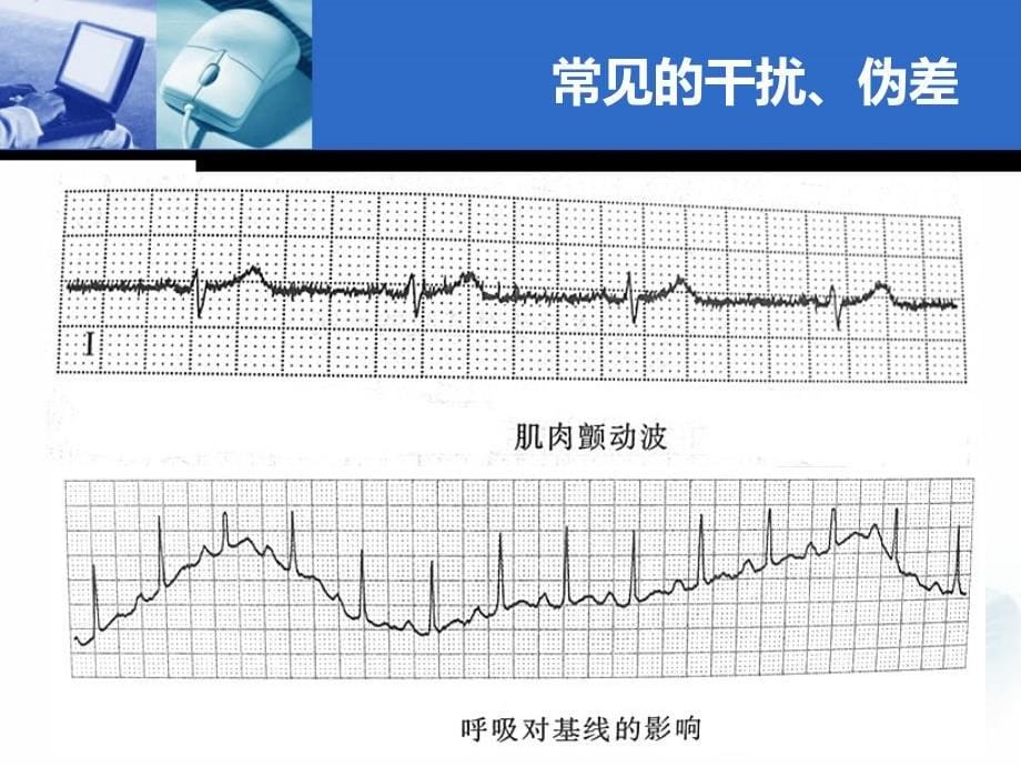 ECG心电图分析(极力推荐)_第5页