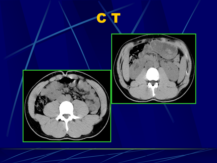 腹部影像诊断-肾脏CT资料_第3页