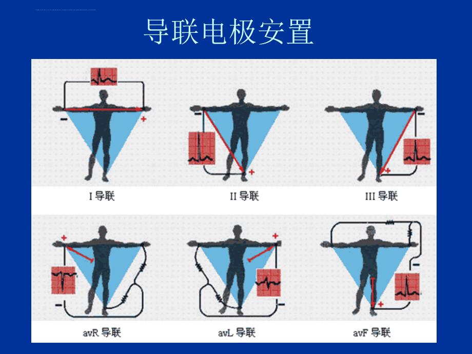 临床心电图浅析课件_第4页