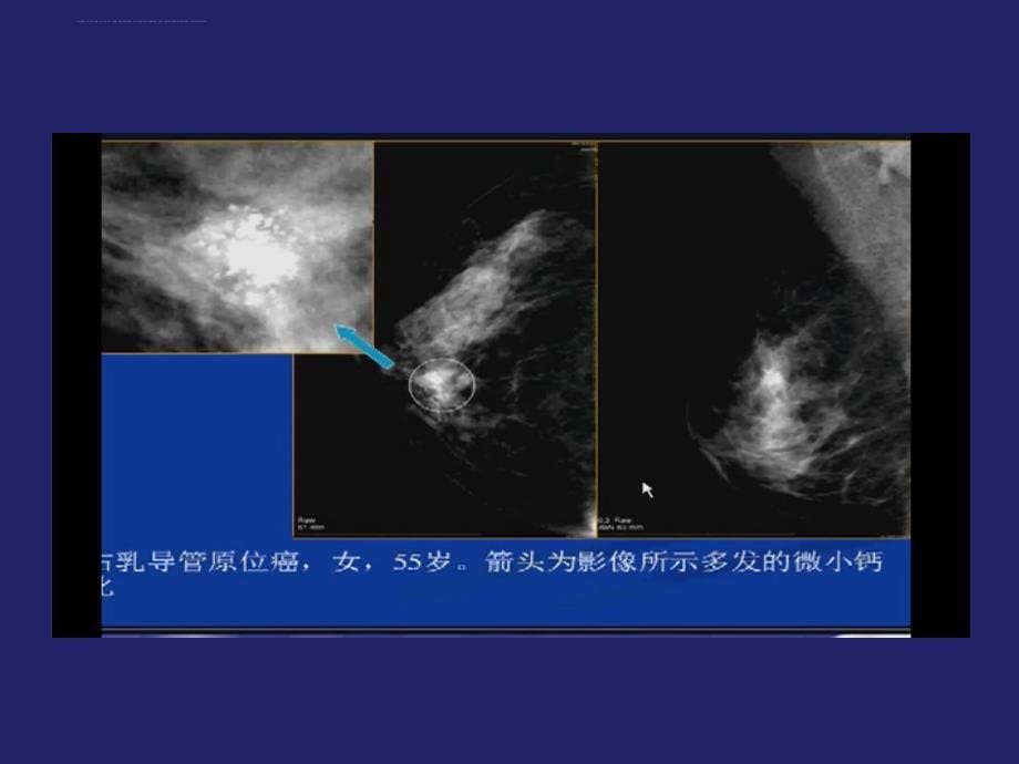 乳腺癌的影像诊断课件_第5页