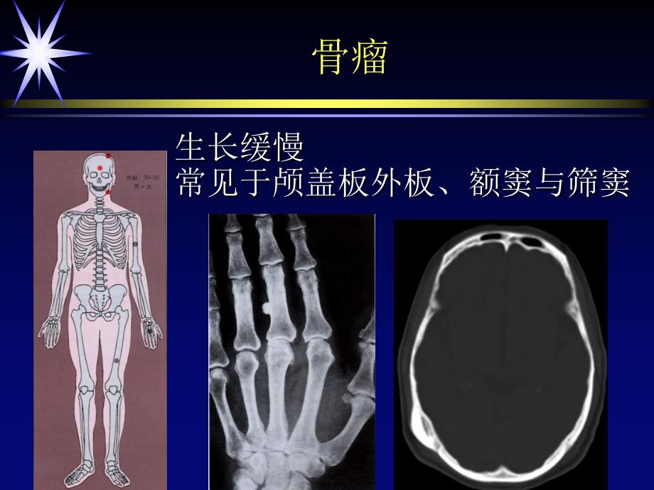 良性骨肿瘤与肿瘤样病变资料_第4页