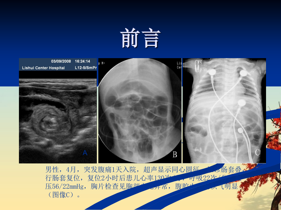 多层螺旋CT在肠梗阻诊断中的医学临床应用_第4页