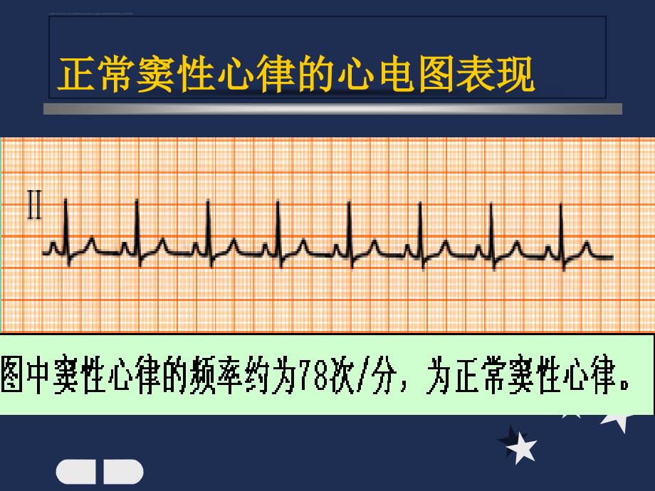 内科窦性心律失常_第3页