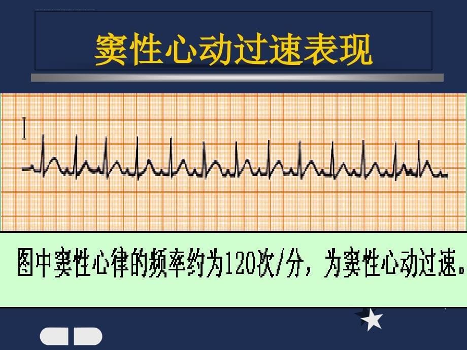 内科窦性心律失常_第5页