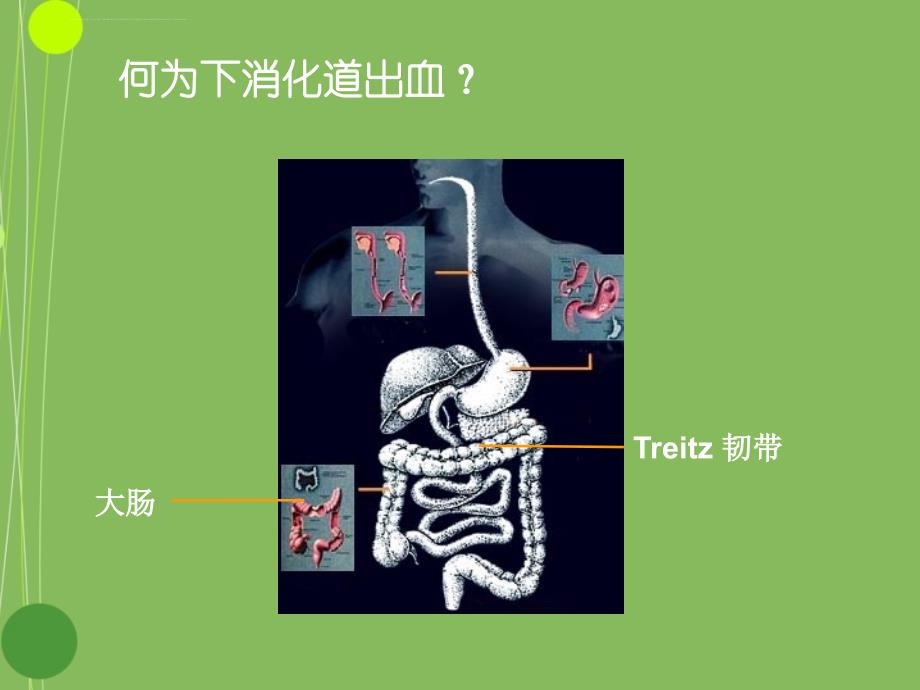 下消化道出血的诊治课件_第2页