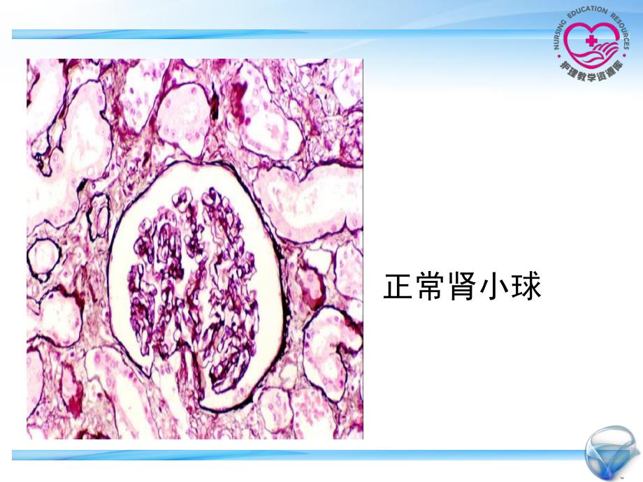 成人护理下册顾志华方志美3-4-电子教案-肾病综合症课件_第4页