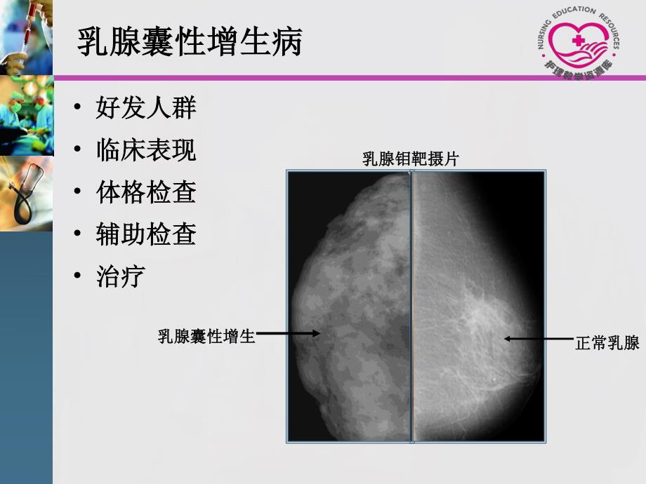 成人护理下册顾志华方志美电子教案15-2乳房肿瘤课件_第3页