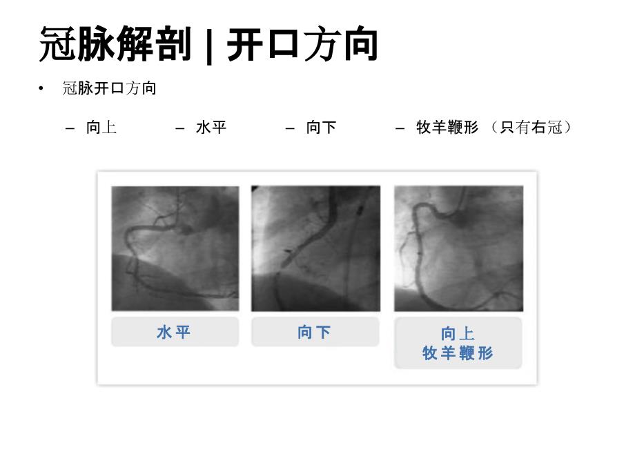 冠心病介入治疗器械概论-指引导管v.1_第3页