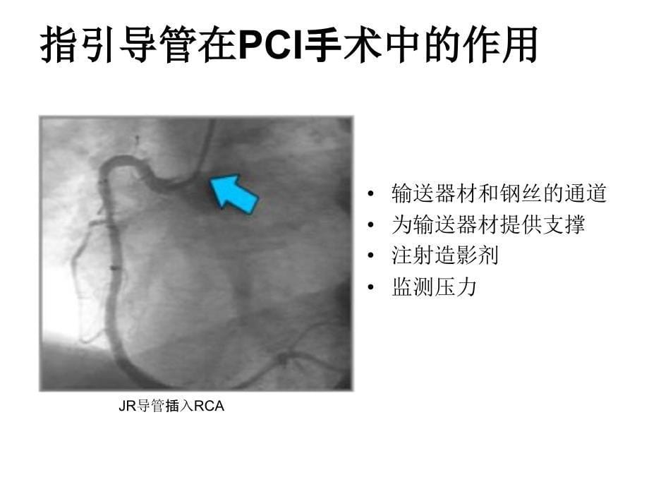 冠心病介入治疗器械概论-指引导管v.1_第5页