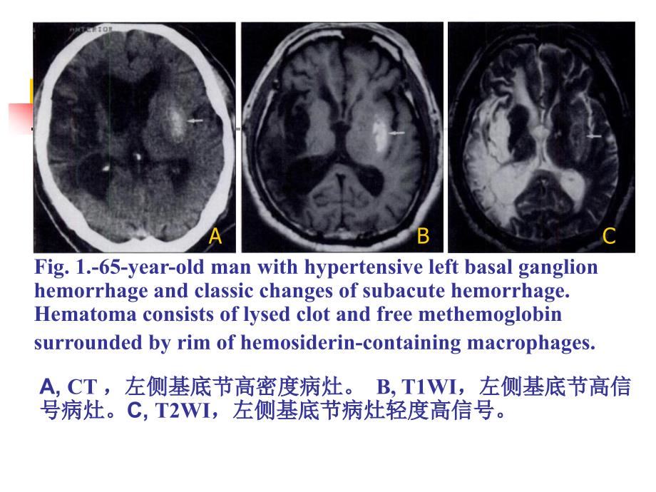 T1WI基底节区高信号病灶的MRI鉴别诊断_第4页