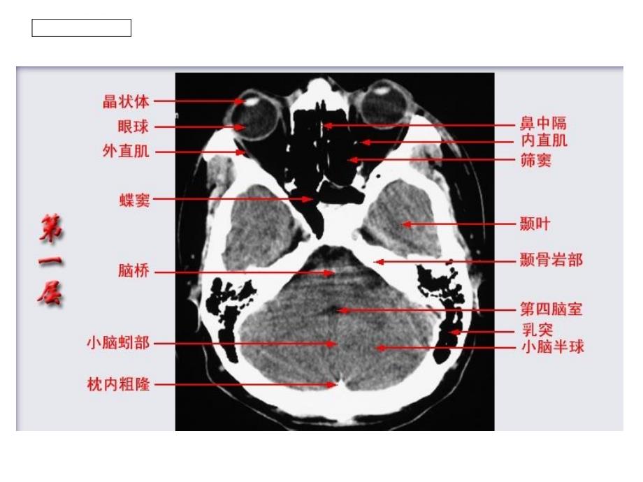 头颅CT影像解剖.ppt_第2页