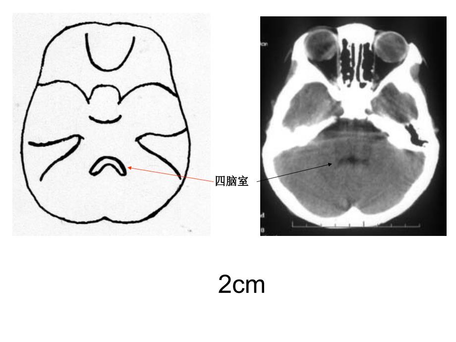 头颅CT影像解剖.ppt_第3页
