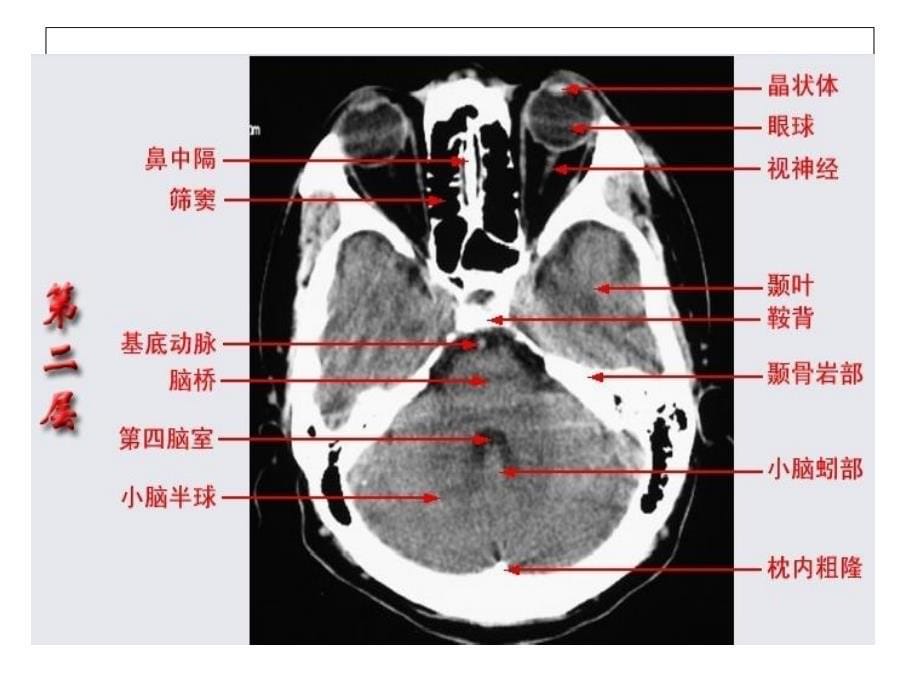 头颅CT影像解剖.ppt_第5页