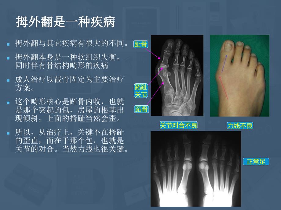 拇外翻分型初探及术式选择_第2页