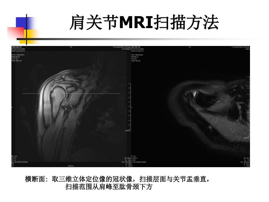 肩关节病变MRI解剖和诊断——课件_第5页