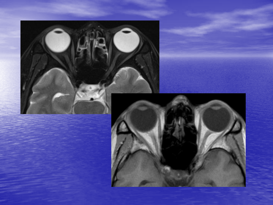 眼眶及眼球病变MR表现_第3页