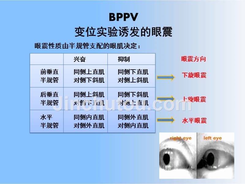 BPPV-CPPV良性位置性眩晕课件_第3页