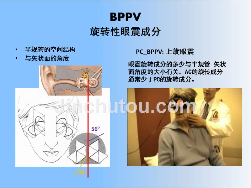 BPPV-CPPV良性位置性眩晕课件_第4页