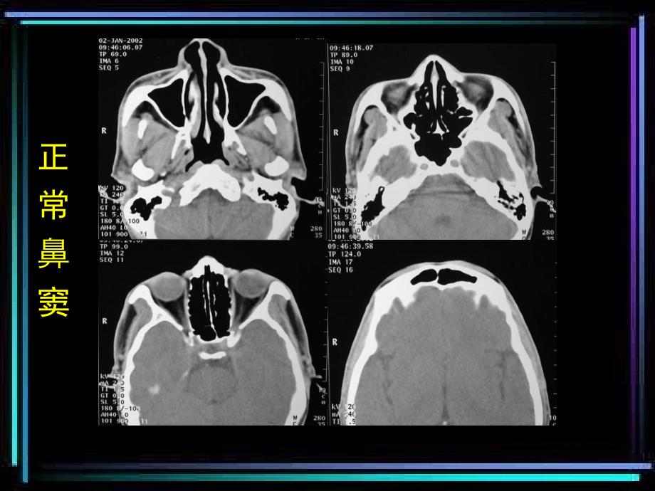 CT诊断学鼻与鼻窦CT_第4页