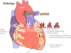 病理学第八版课件心血管系统疾病