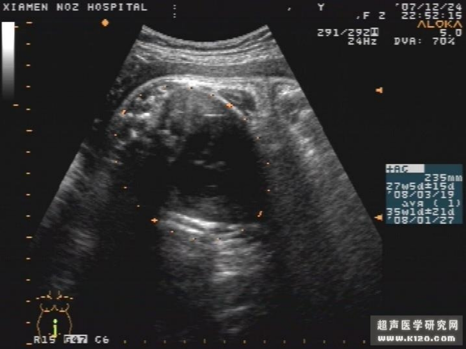 产科胎儿各种B超图片_第3页