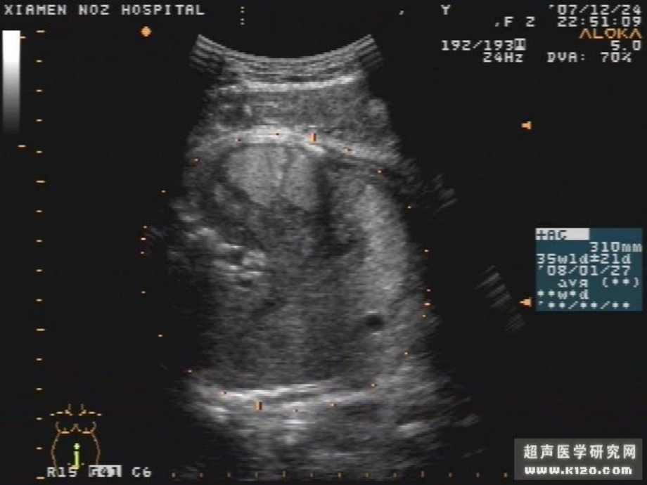 产科胎儿各种B超图片_第4页
