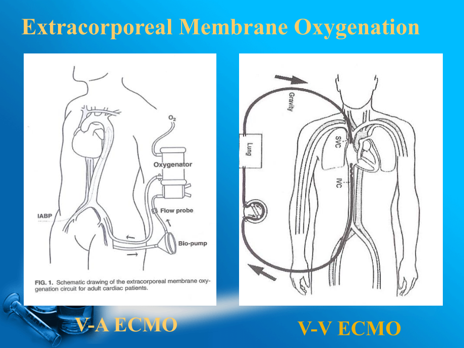 李景文-ECMO器材设备_第2页