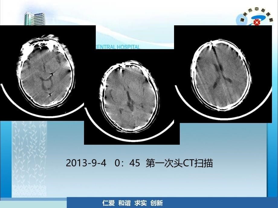 死亡病例讨论(李付)_yanai讲解_第5页