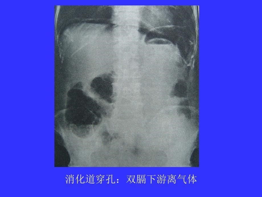 放射诊断学基础(消化系统读片基础)教材_第5页