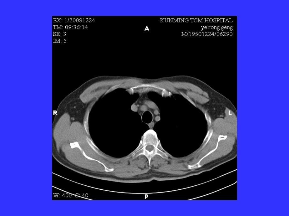 胸部ct片阅读重点总结课件_第5页