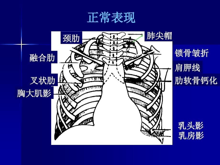 如何阅读胸片剖析_第5页