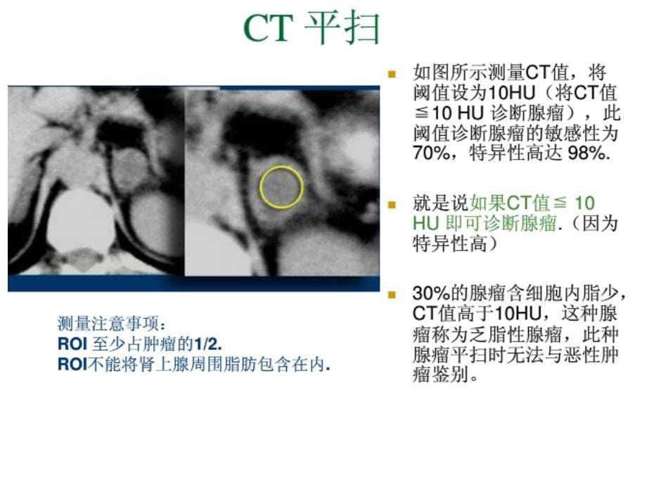 肾上腺CT鉴别诊断_第5页