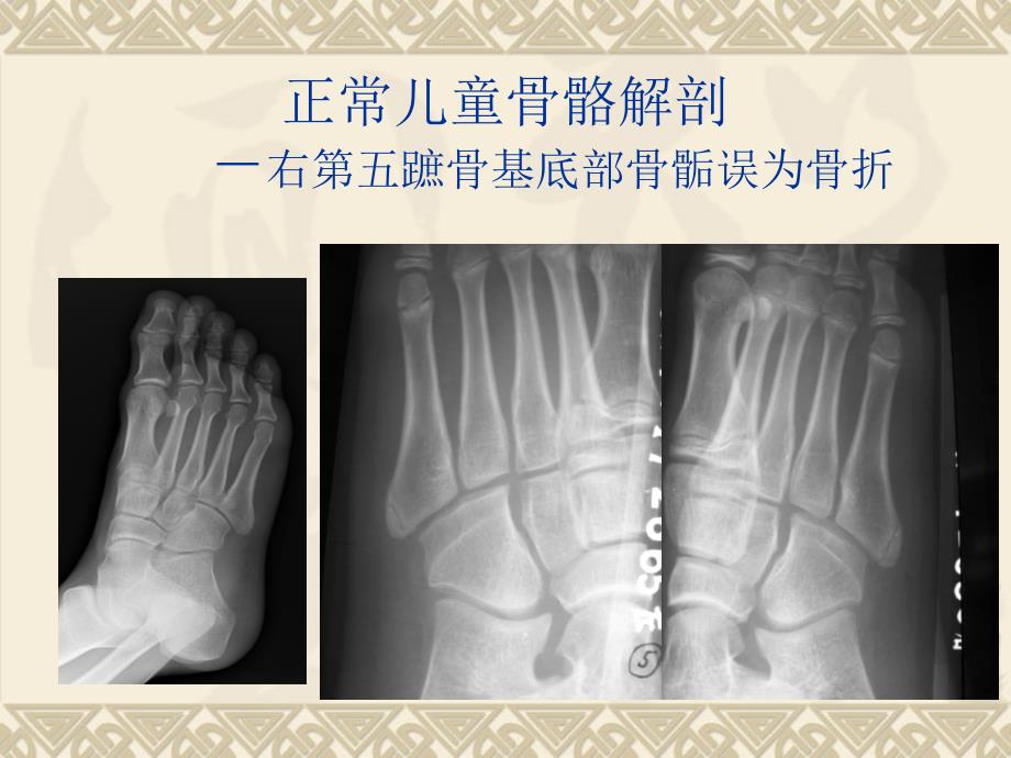 医学影像怎样鉴别骨折与正常骨_第4页