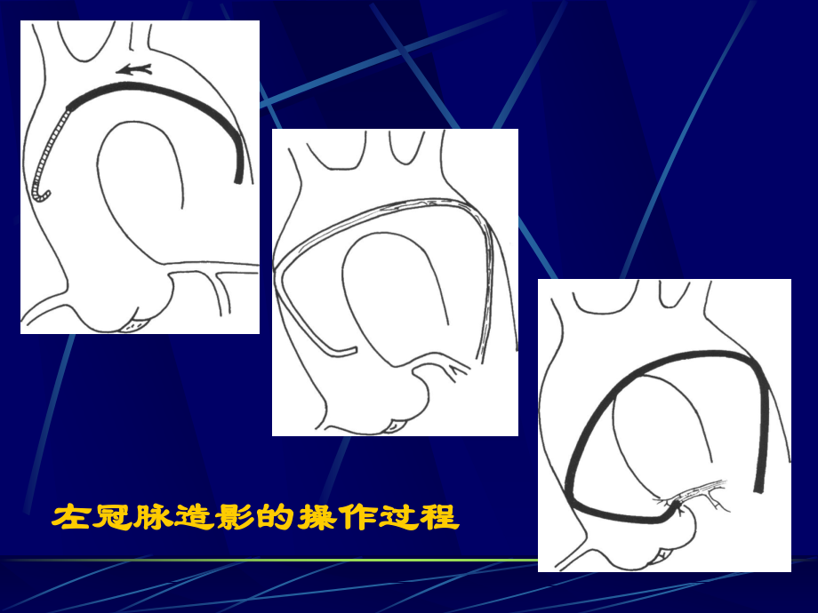 冠脉造影术教材_第2页