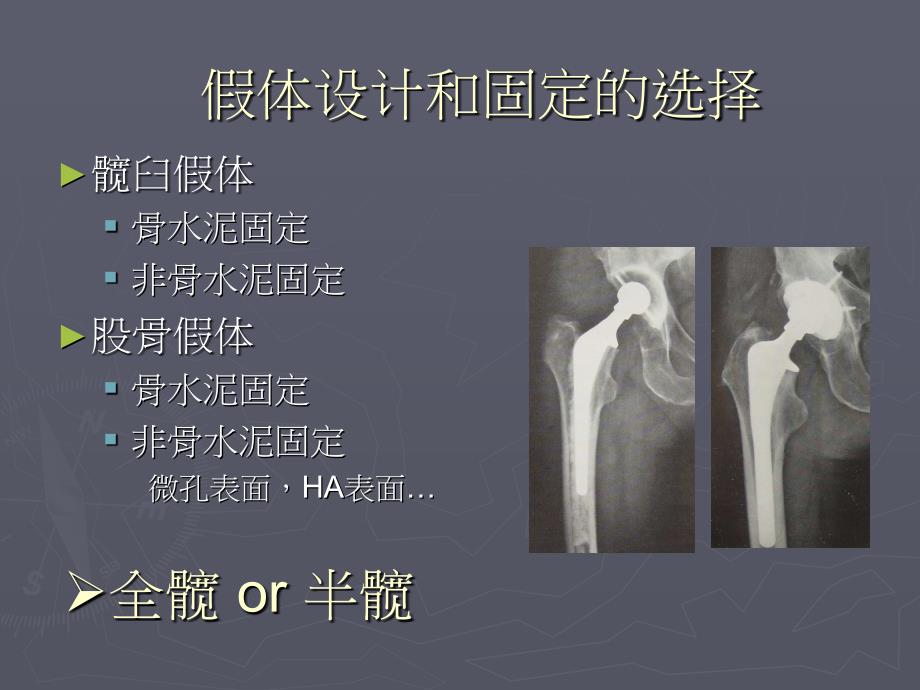 联合人工髋关节手术过程汇编_第2页