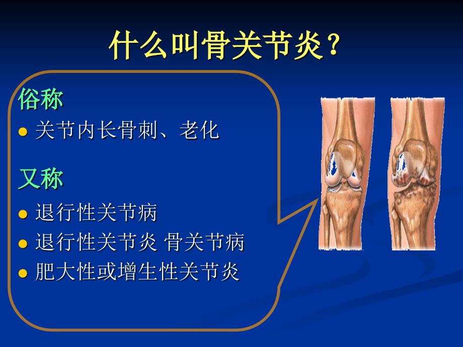 膝关节骨性关节炎的分级治疗6.3讲解_第2页