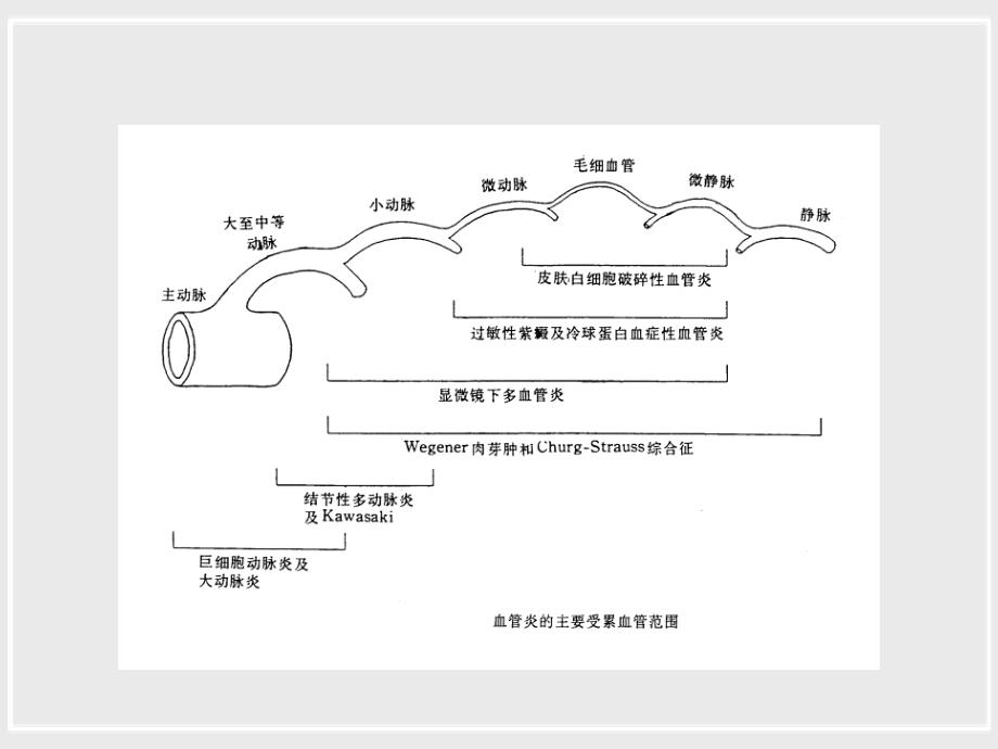 anca相关性小血管炎诊治进展_第4页