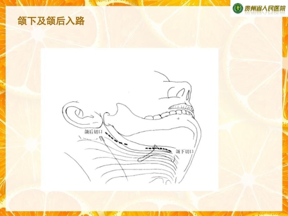 下颌骨骨折手术治疗解读_第5页