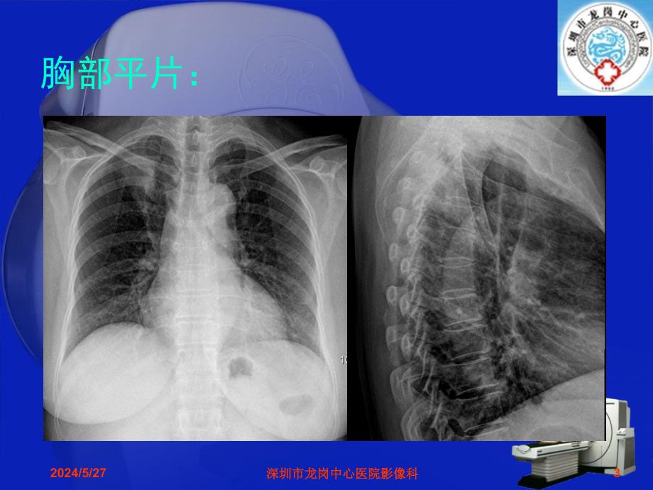 影像科经典读片之二：肺炎性假瘤影像诊断分析讲解_第3页