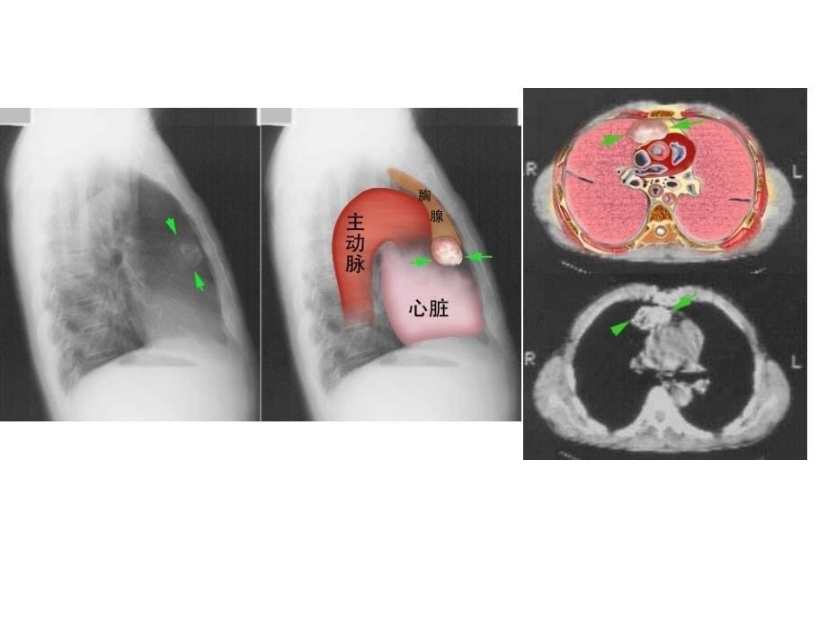 胸腺瘤的CT诊断讲解_第5页
