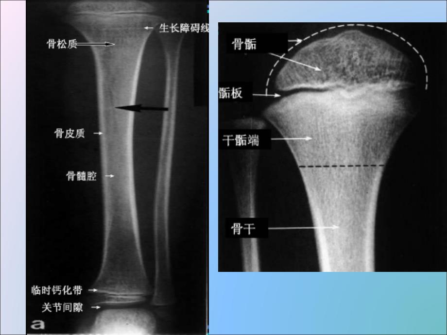 骨x线解剖及基本病变_第4页