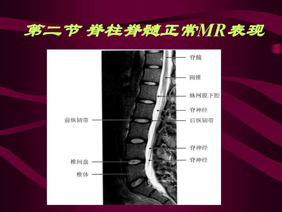 影像学,脊柱和脊髓病变MRI诊断讲解_第4页
