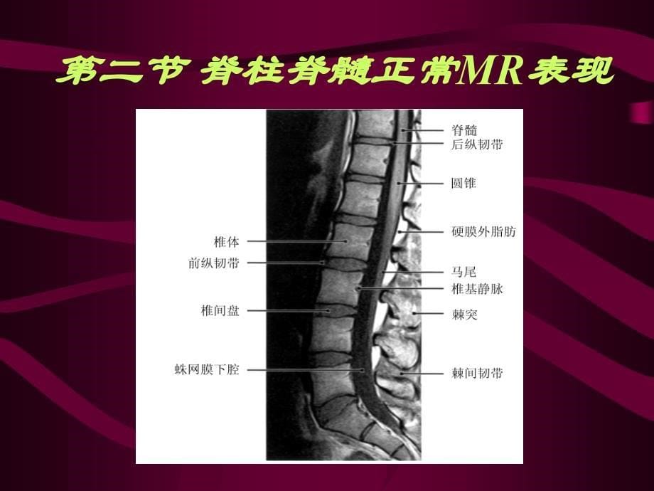 影像学,脊柱和脊髓病变MRI诊断讲解_第5页