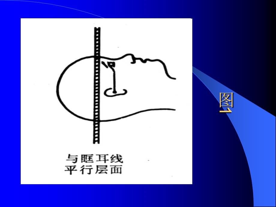 脑肿瘤的CT诊断1_第5页